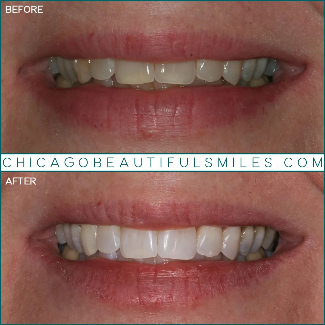 /img/27120-teeth-whitening-sensitivity.webp