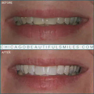 /img/27120-teeth-whitening-sensitivity.webp