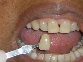 /img/27122-north-carolina-tooth-whitening-before-after.webp