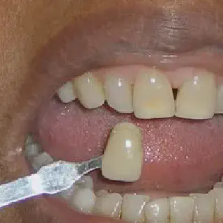 /img/27122-north-carolina-tooth-whitening-before-after.webp