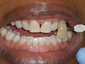 27122 north carolina tooth whitening dentist