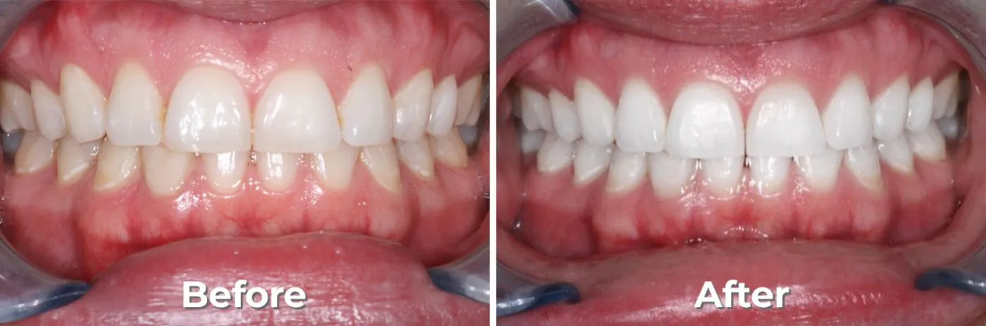 27122 north carolina tooth whitening diet