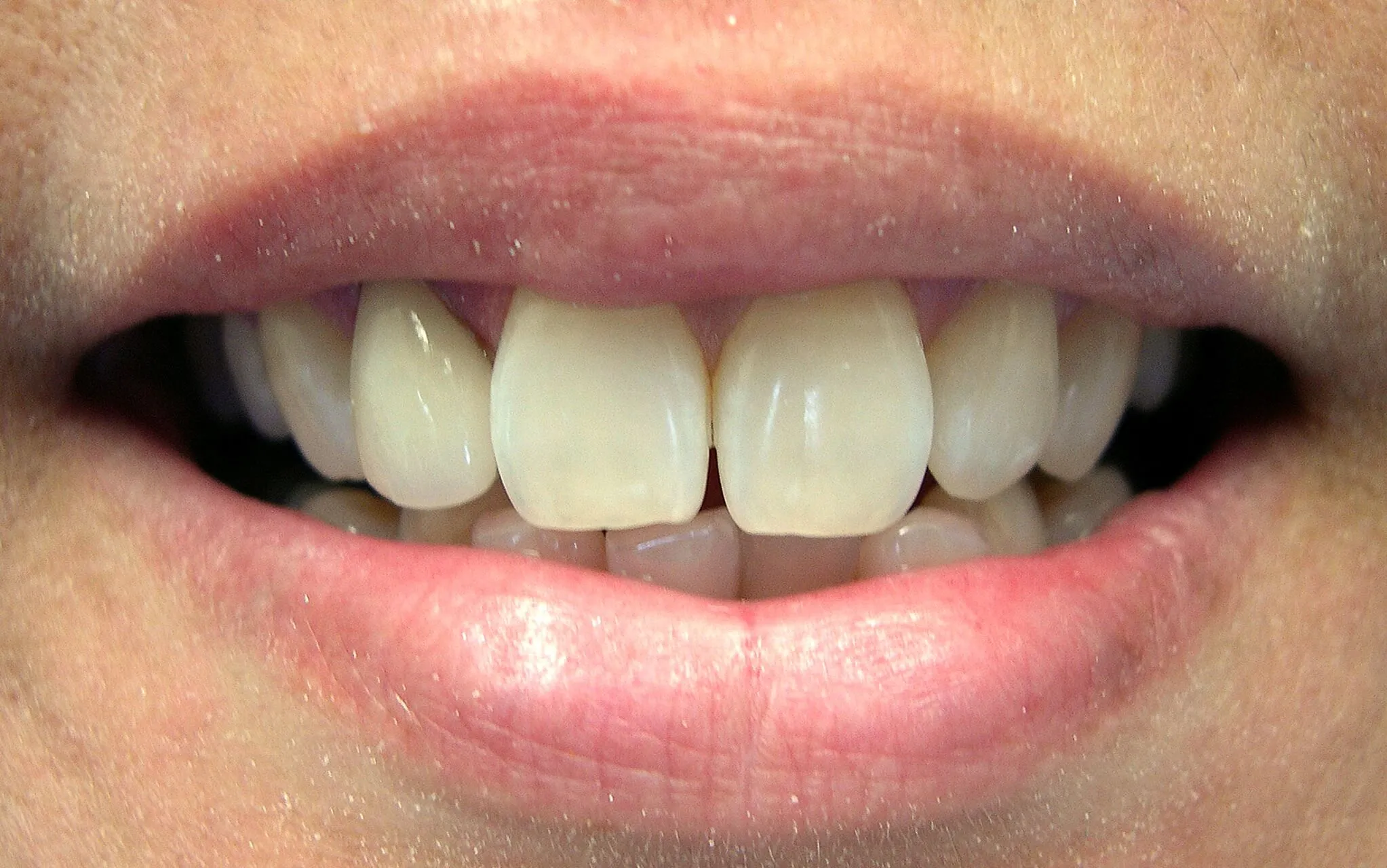 27125 teeth whitening process