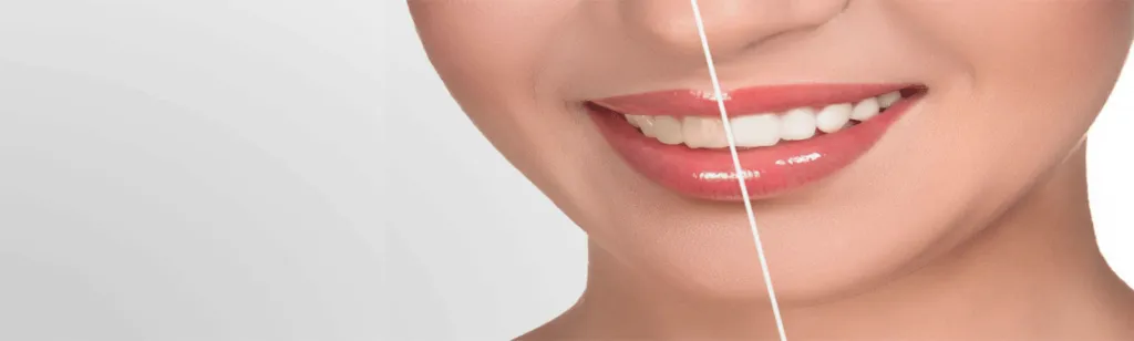 27125 teeth whitening smile