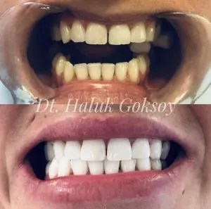 27131 teeth whitening smile
