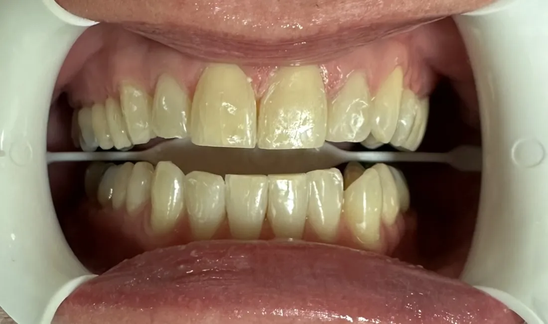 27133 glo blanc whitening peel application