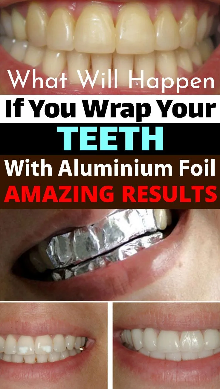 27144 teeth whitening foil 3