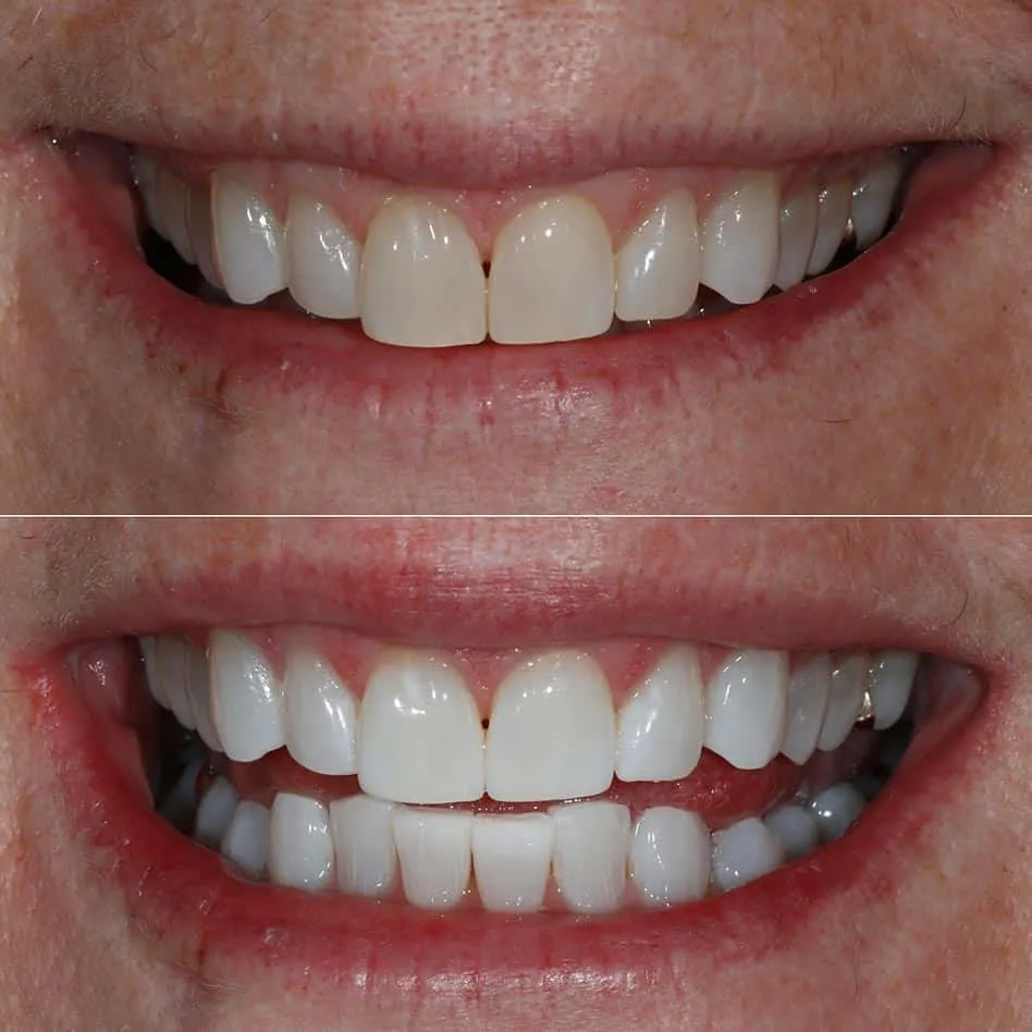 27148 dental clinic zoom whitening