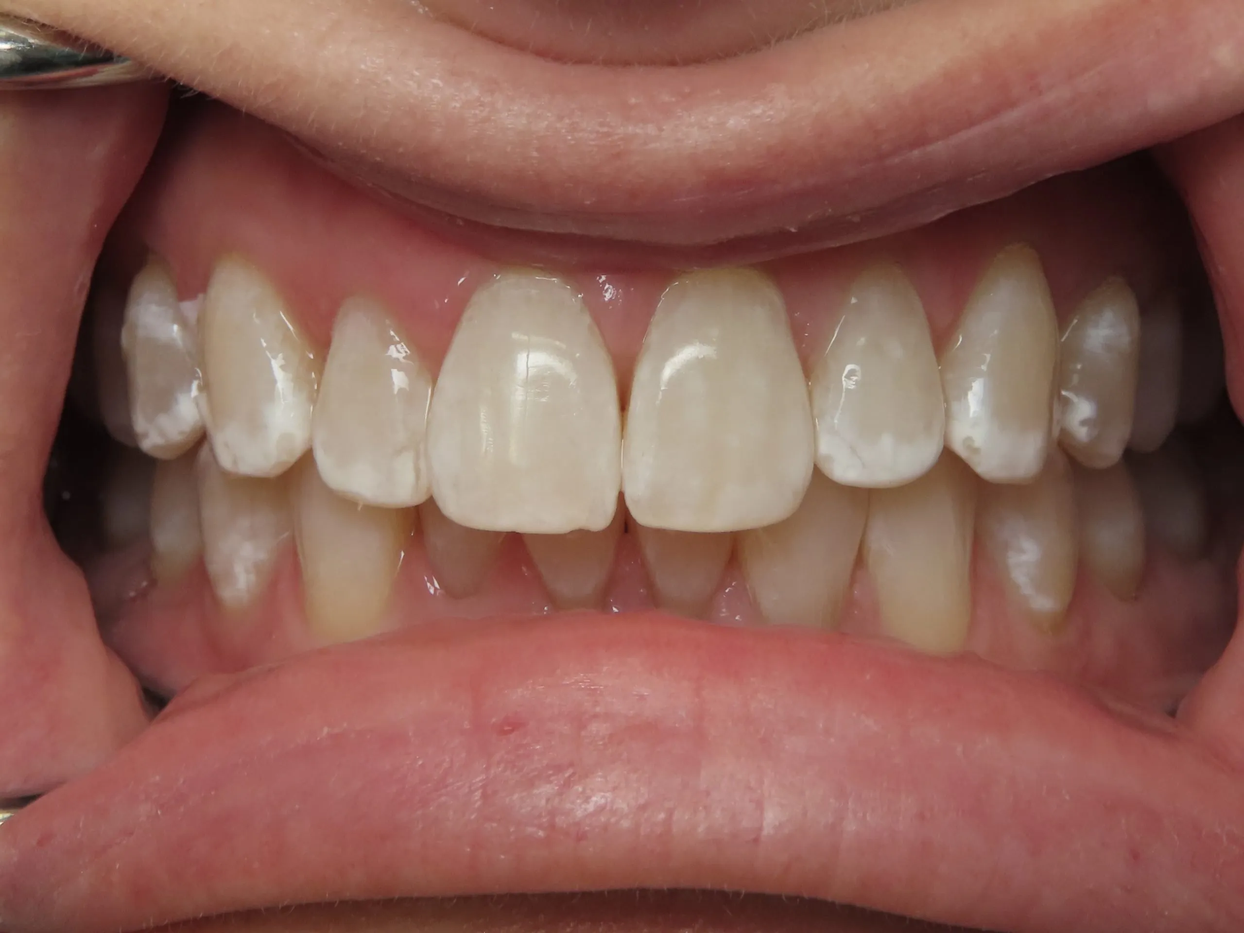 27148 teeth whitening options