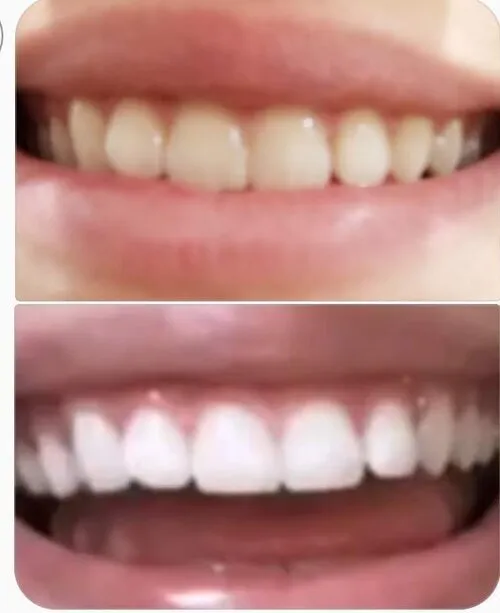 27155 teeth whitening peoria az confidence