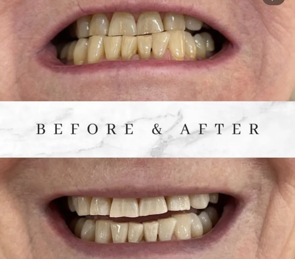 27161 at home teeth whitening