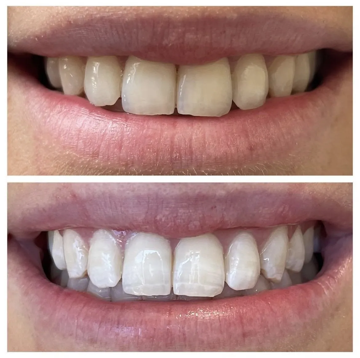 27161 choosing teeth whitening