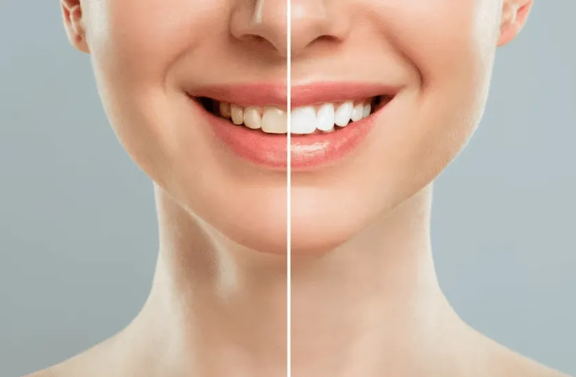 27197 berries teeth staining