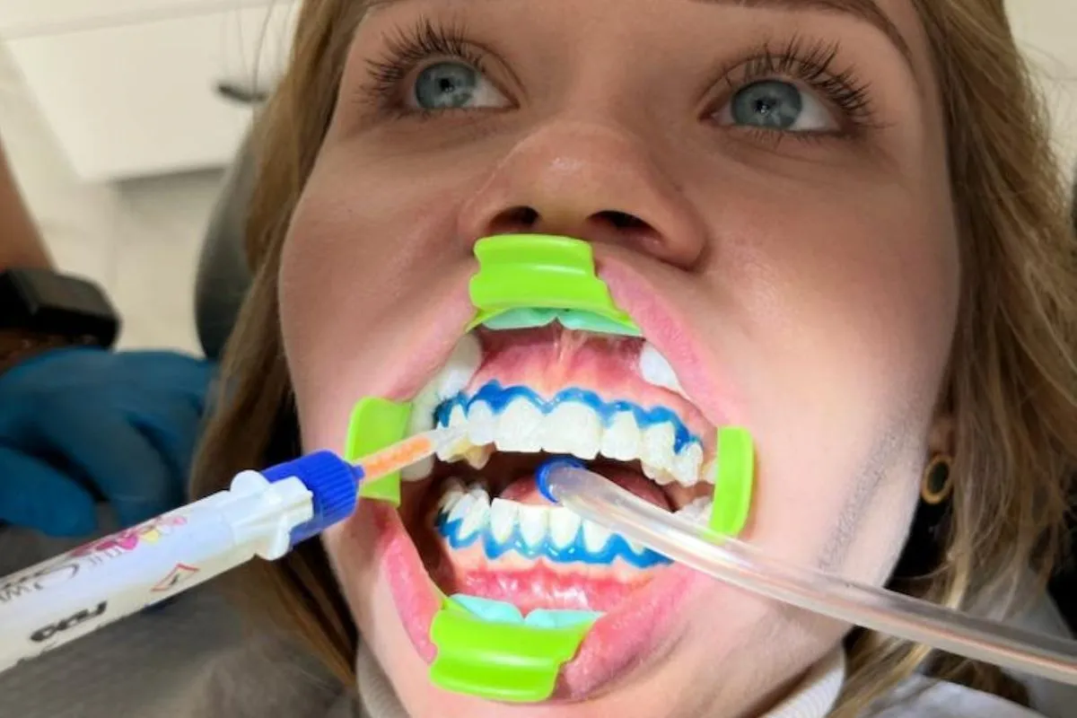 /img/27207-teeth-whitening-stockton-heath-image8.webp