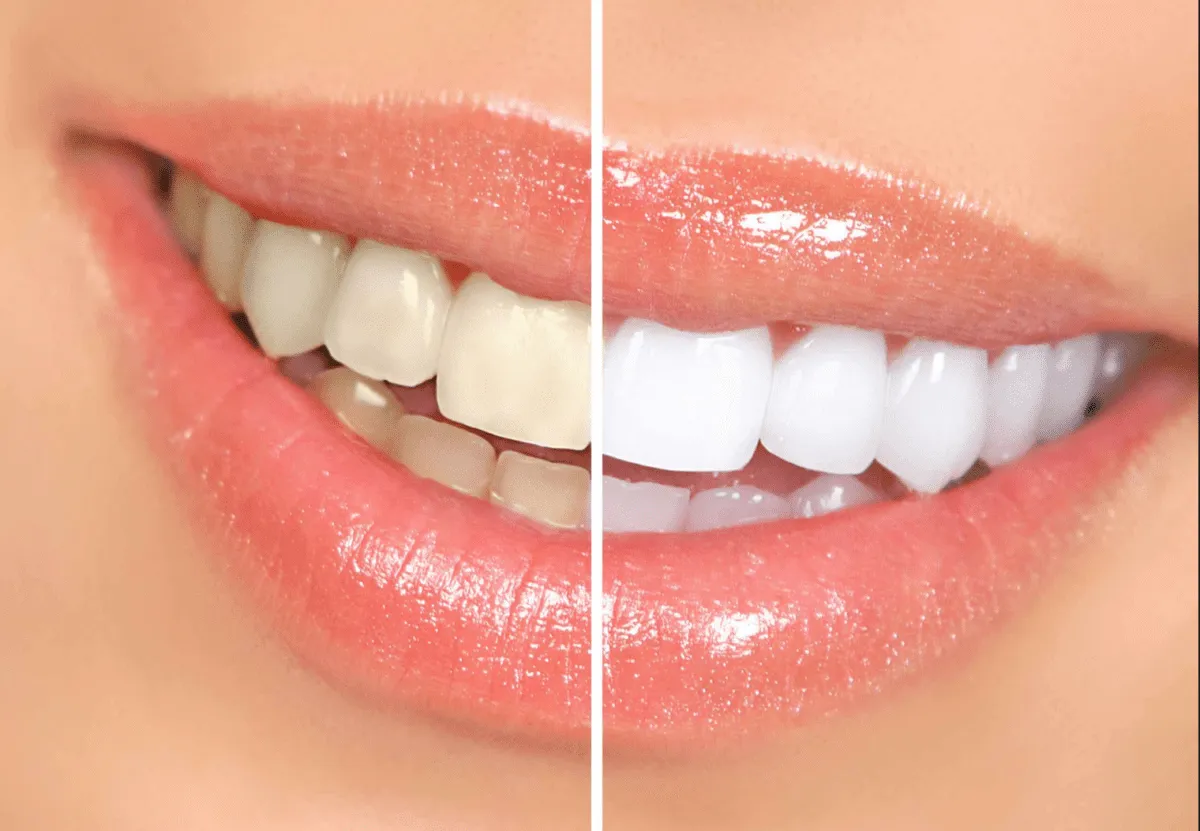 /img/27210-bleachbright-teeth-whitening-diet.webp