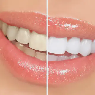 /img/27210-bleachbright-teeth-whitening-diet.webp