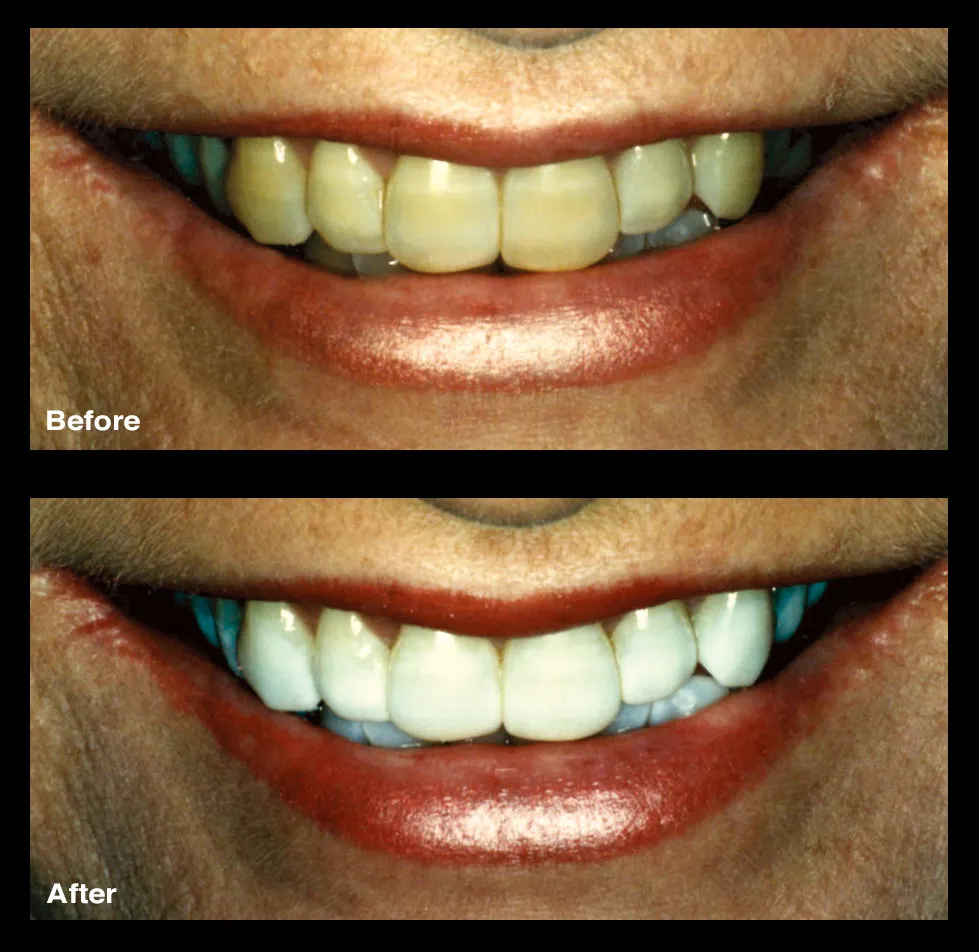 27210 bleachbright teeth whitening sensitivity