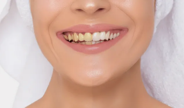 27218 at home teeth whitening