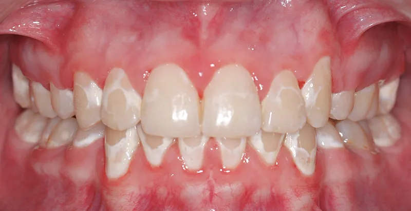 27222 fluorosis teeth