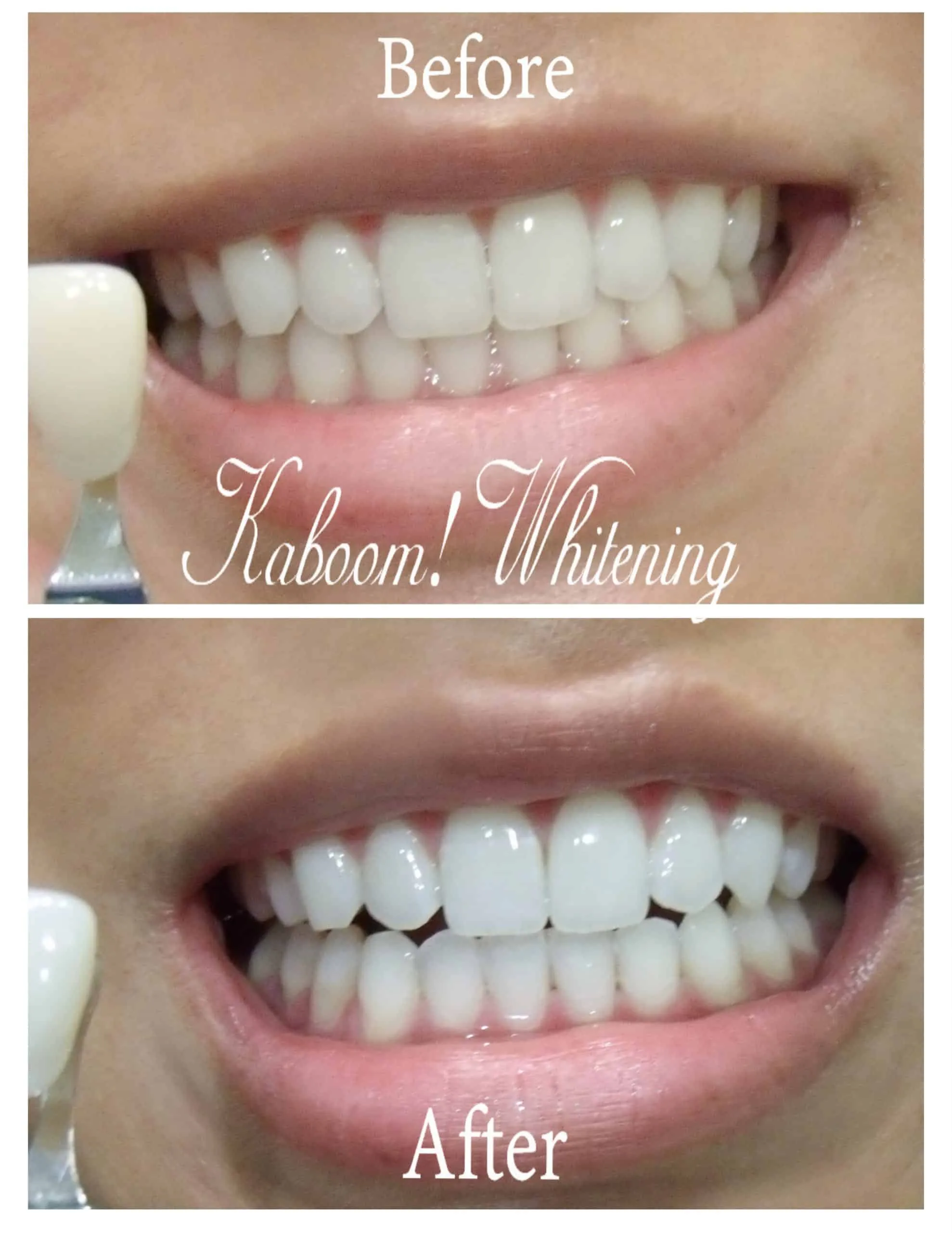 27223 teeth whitening cost factors