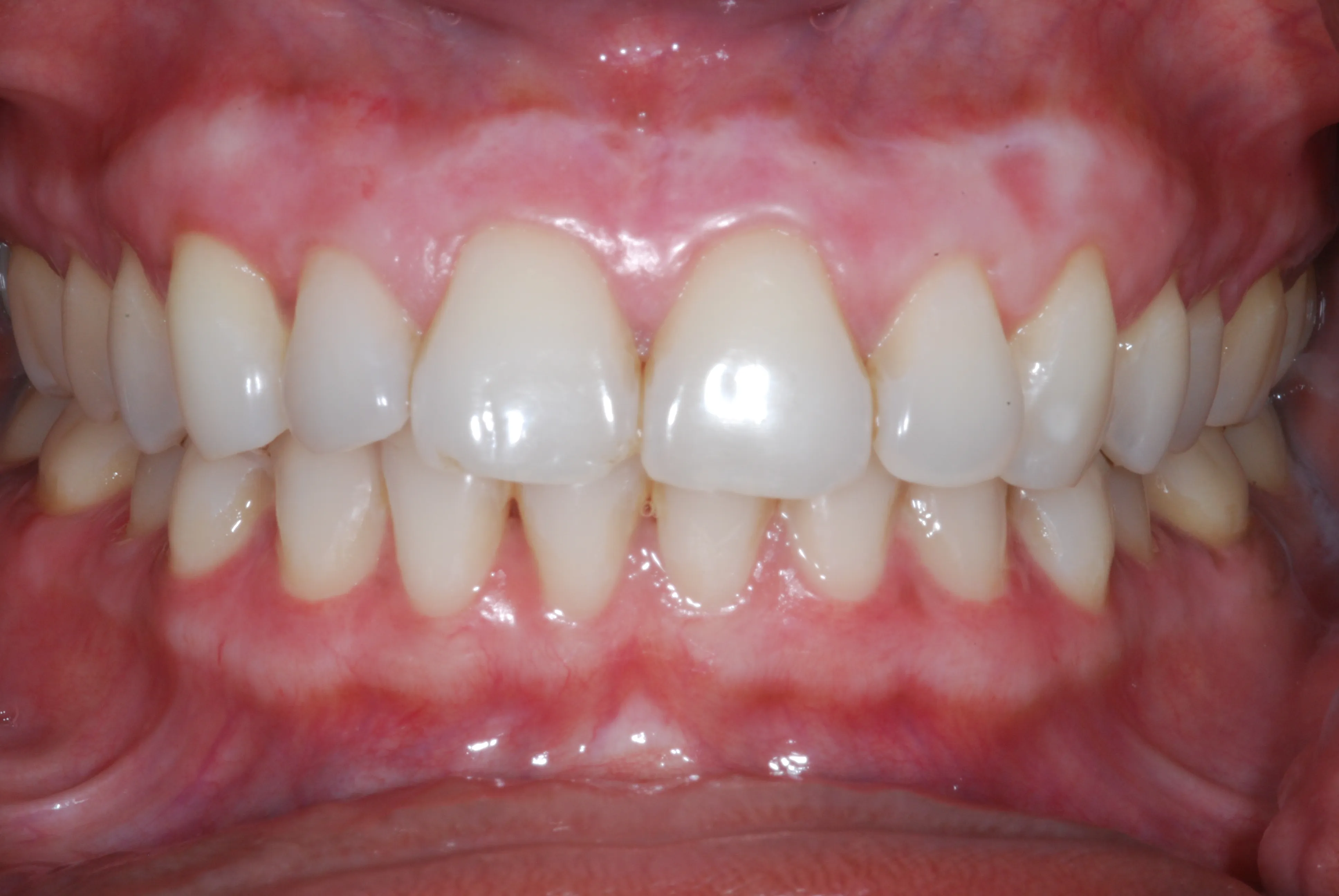27224 fluorosis