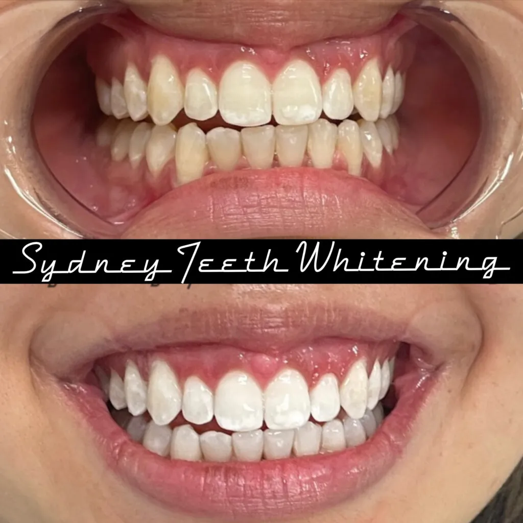 27224 professional teeth whitening