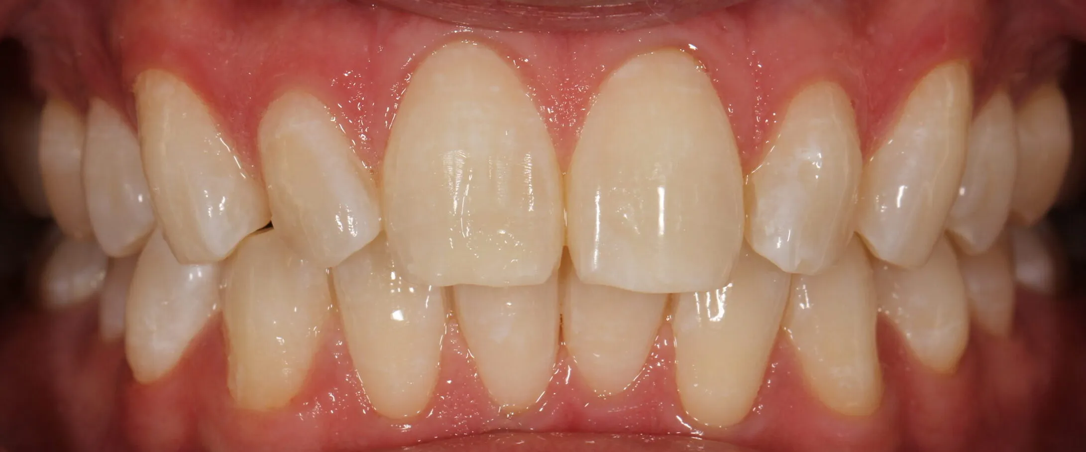 27224 white spots teeth