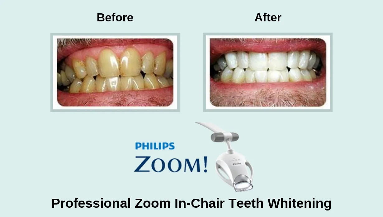 27230 venus teeth whitening