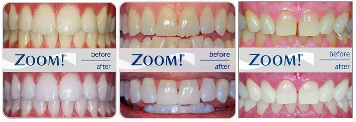 27230 zoom teeth whitening