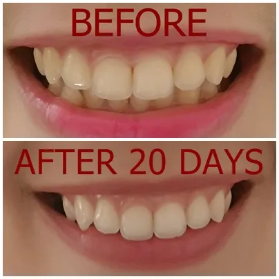 27233 whitening strips