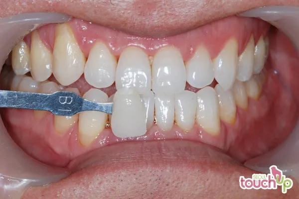 27235 teeth whitening maintenance