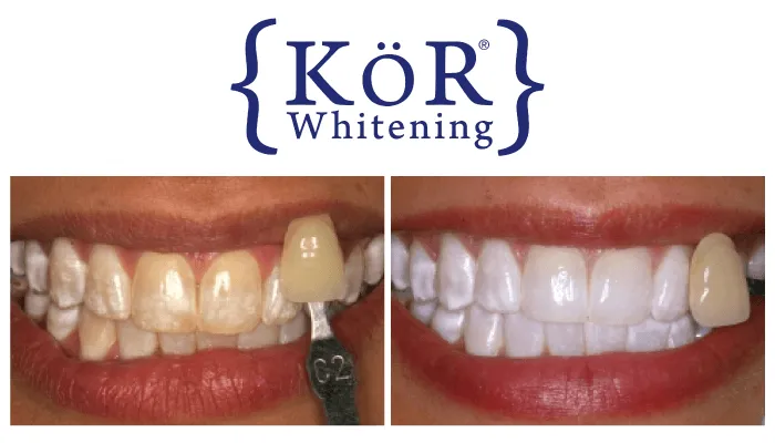 27236 at home teeth whitening kits