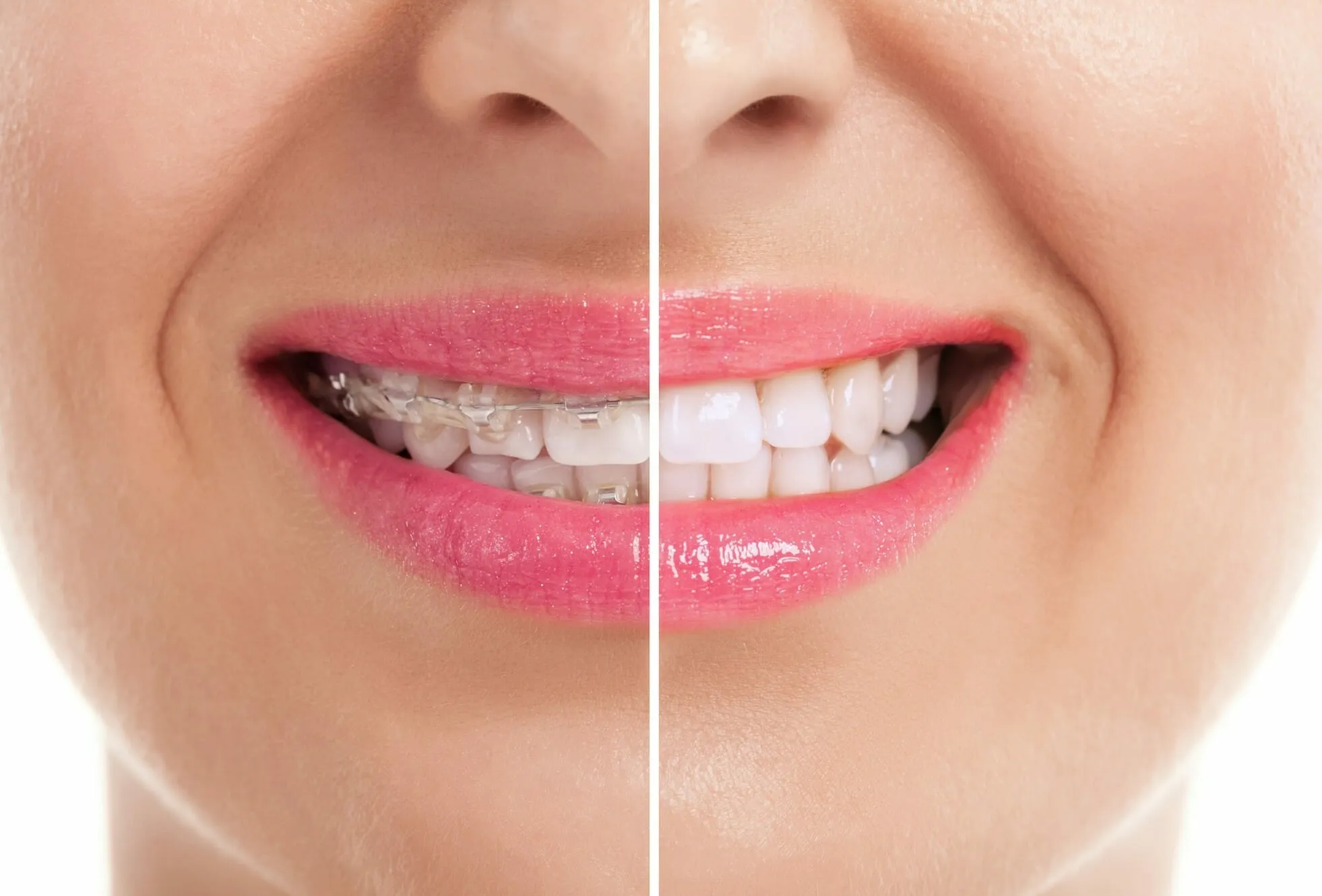 27241 teeth whitening after braces 2