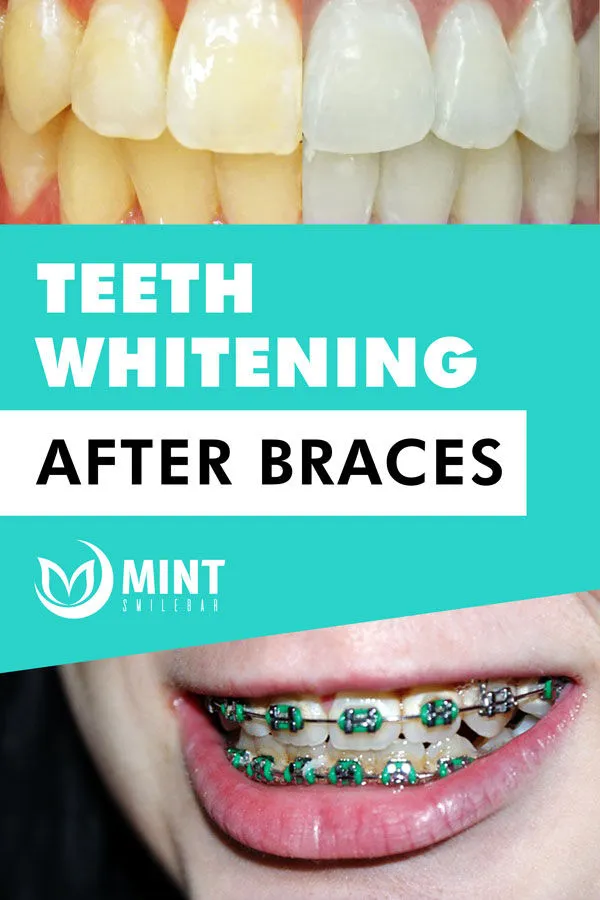 27241 teeth whitening after braces 5