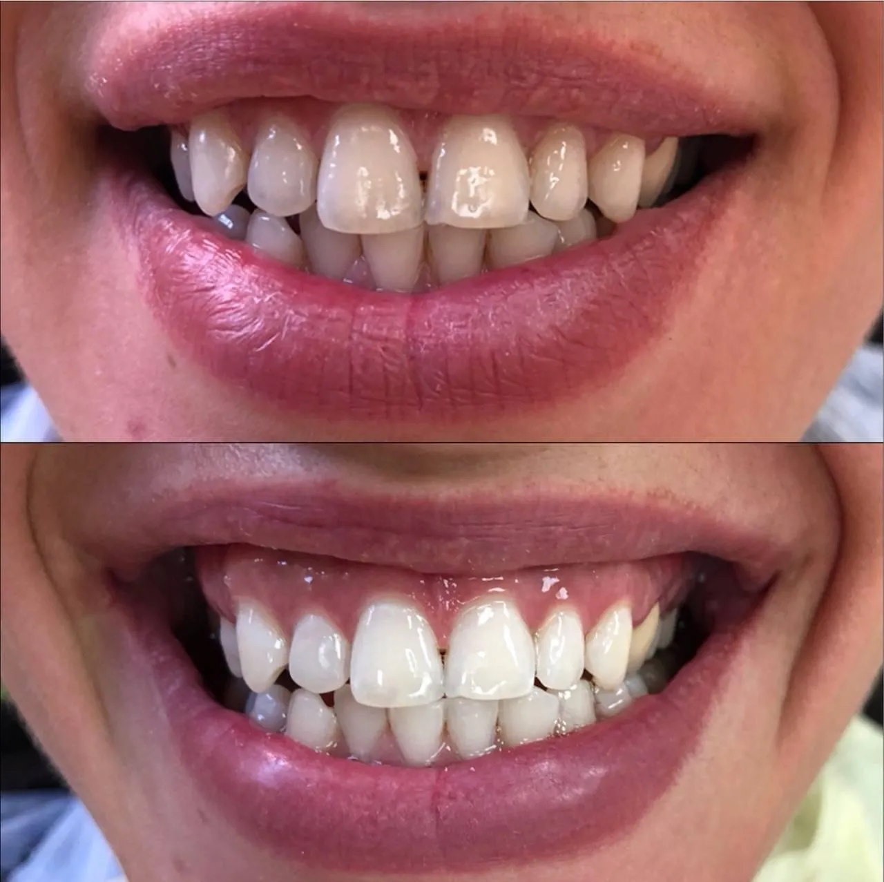 27242 teeth whitening bloomington il image6