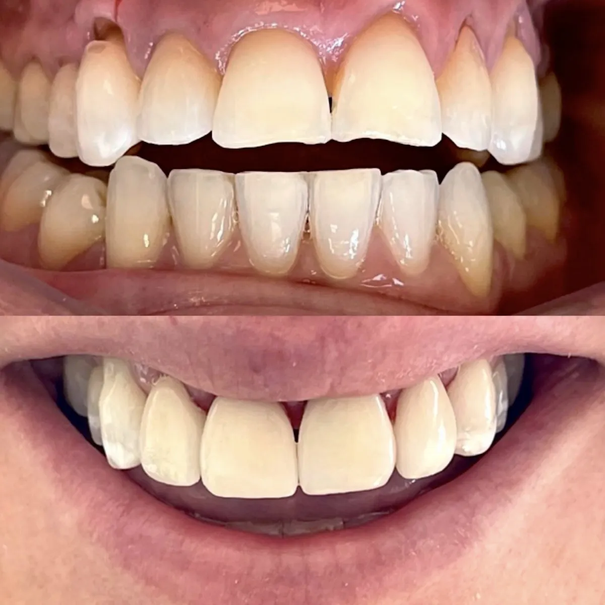 27247 at home teeth whitening kits