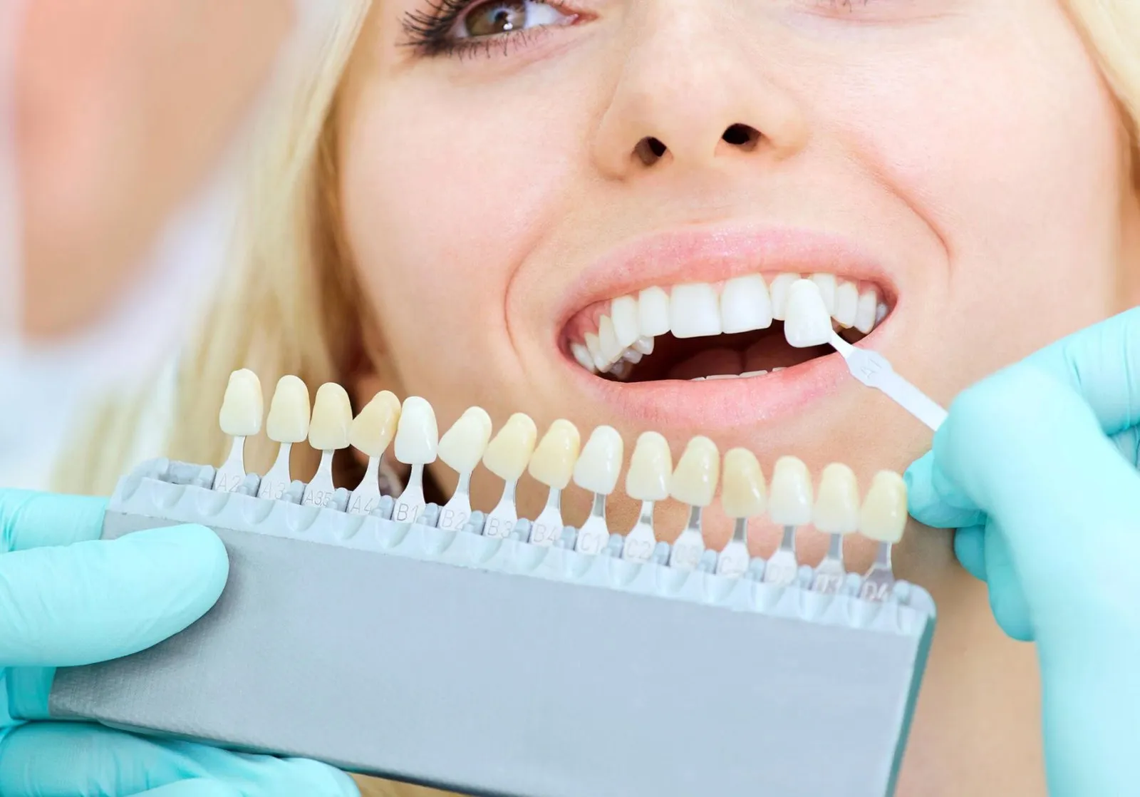 27247 professional teeth whitening