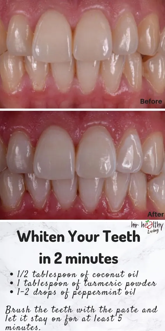 27265 before after teeth whitening