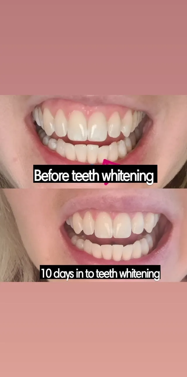 27265 professional teeth whitening