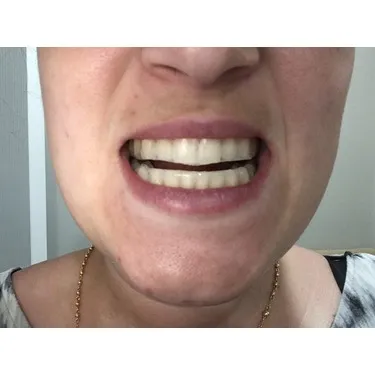 27265 whitening strips application