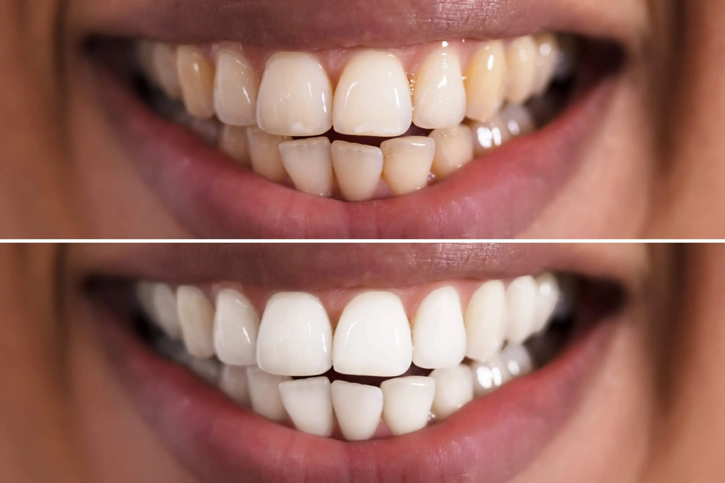 27274 teeth whitening birmingham treatment