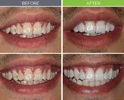 27276 dental bonding veneers