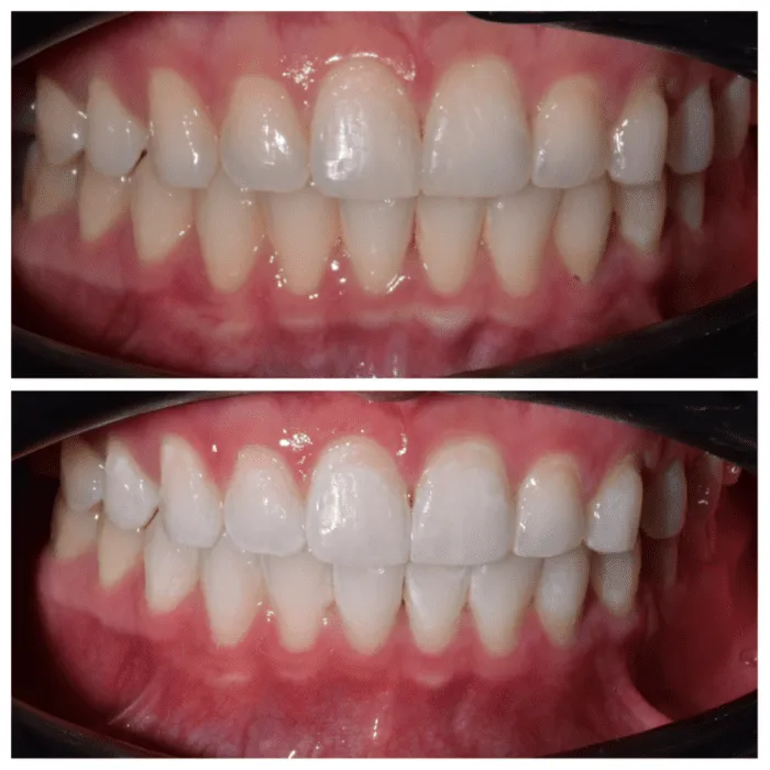 27282 zoom whitening baton rouge confident smile