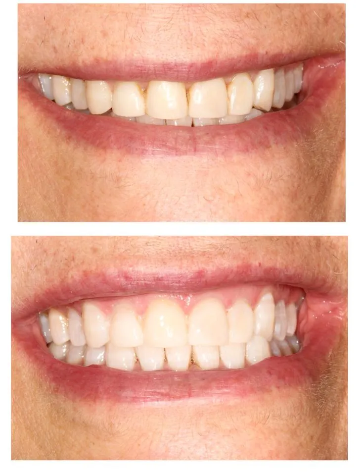 27282 zoom whitening baton rouge procedure