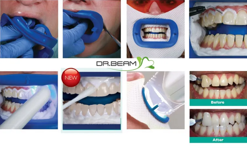 27282 zoom whitening baton rouge smile comparison