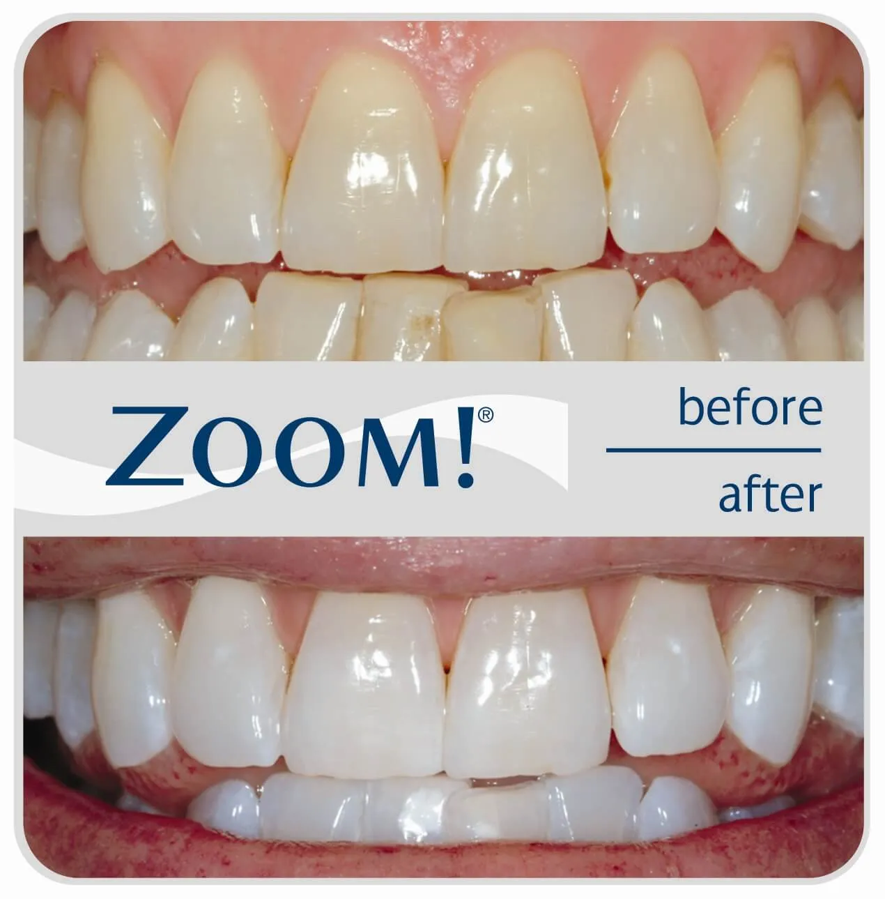 27293 teeth whitening cost