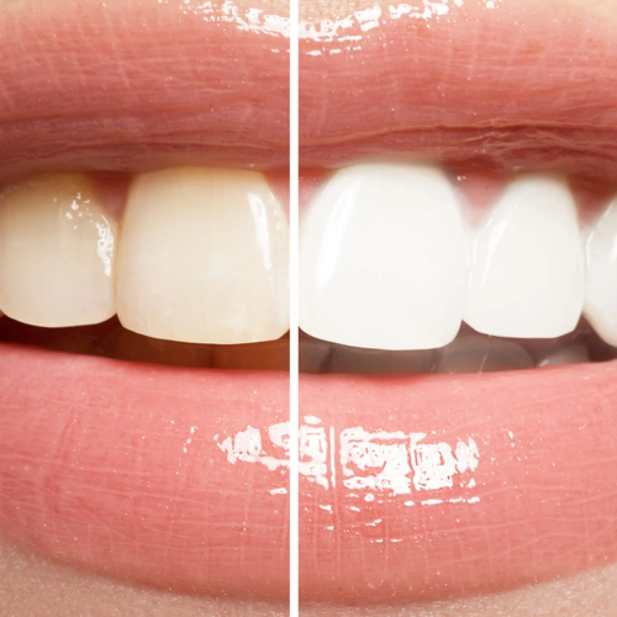 27294 teeth whitening consultation