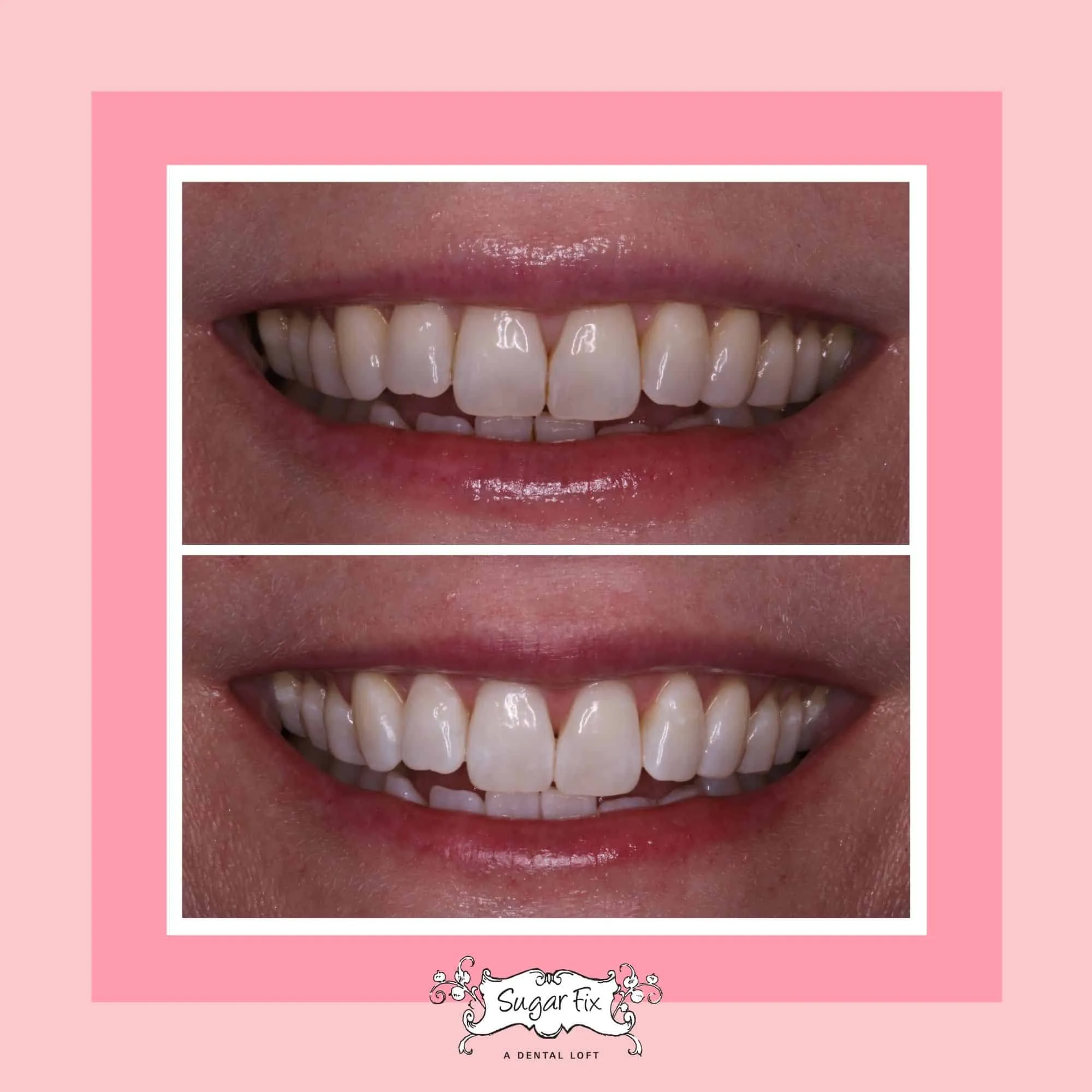 27296 dental flossing