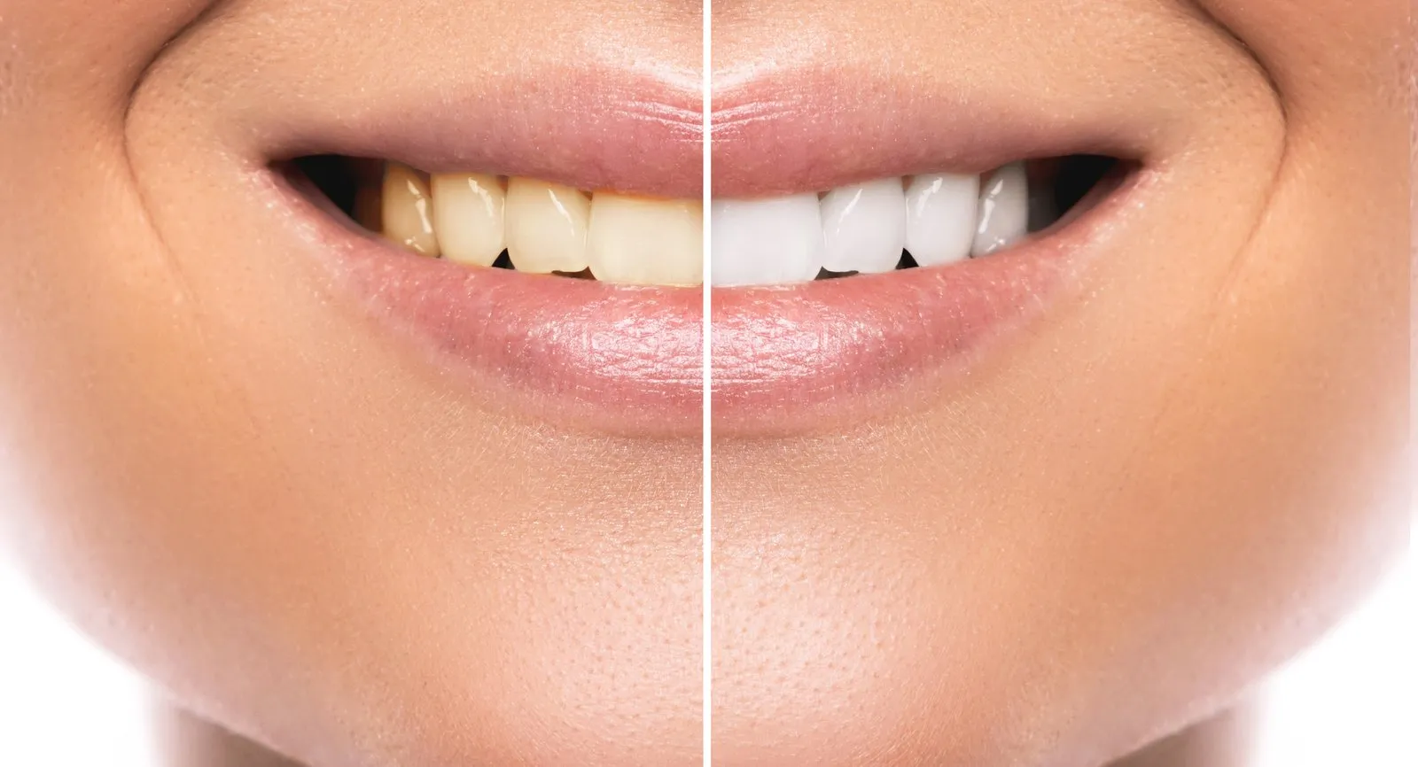 27298 teeth whitening costa rica before after