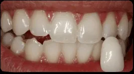 27298 teeth whitening costa rica procedure